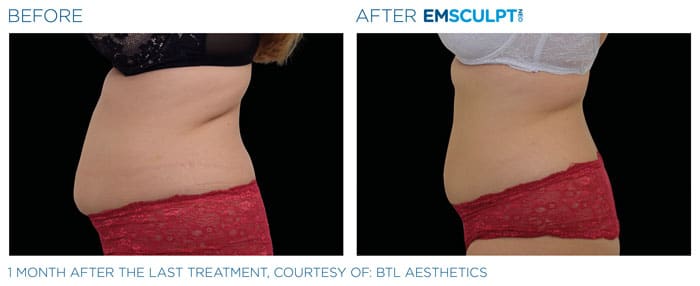 How Does the EMSCULPT NEO Work?